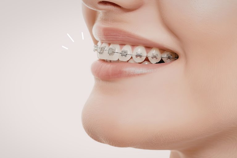 ワイヤー矯正との違い