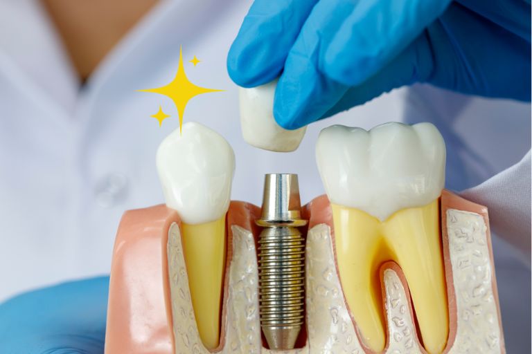 インプラントのメリット｜アーバン歯科 池袋駅前院