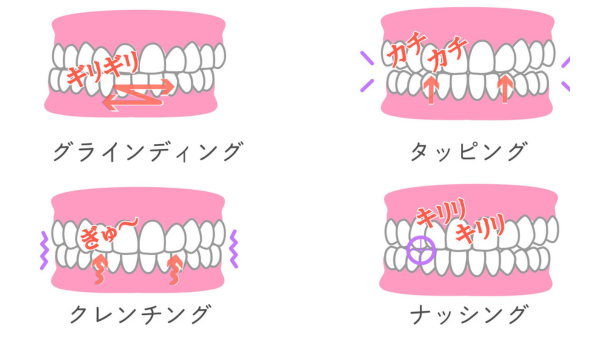 歯ぎしりの種類