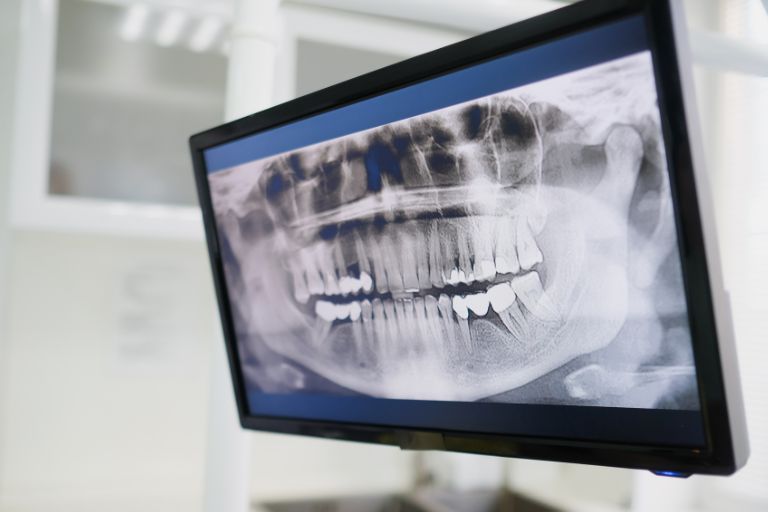 インプラントの適応症例